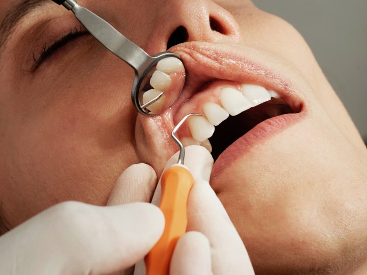Зубные импланты: какую опасность они несут для здоровья